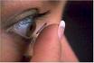 Contact Lens for Keratoconus